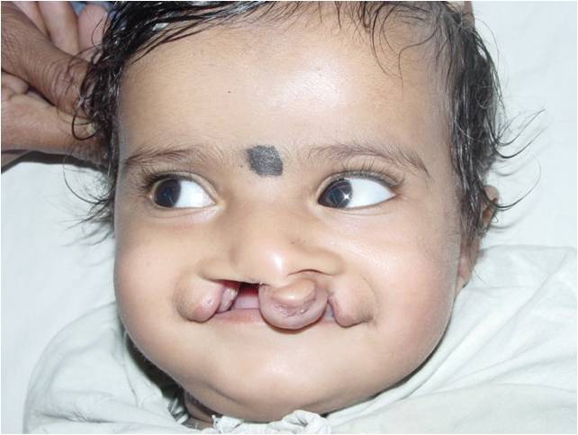 Cleft Before Surgery