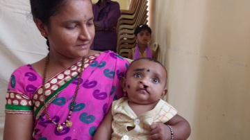 free cleft lip surgery karnataka by trinity care foundation