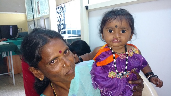 Free cleft lip surgery Karnataka